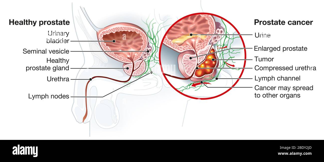 Illustrazione medica che mostra la ghiandola prostatica sana e il cancro della prostata, Foto Stock