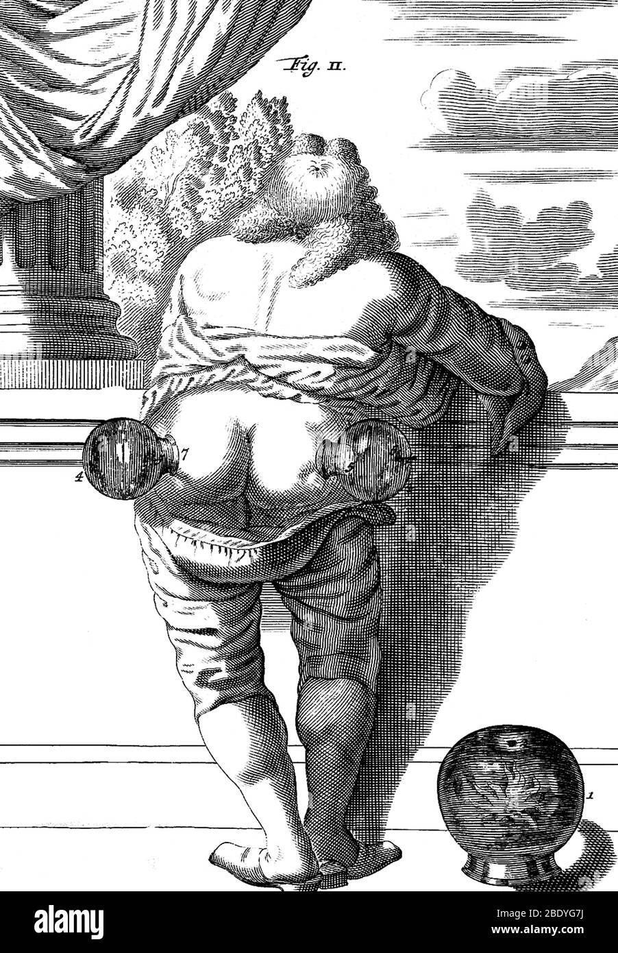 Terapia di cupping, 1694 Foto Stock