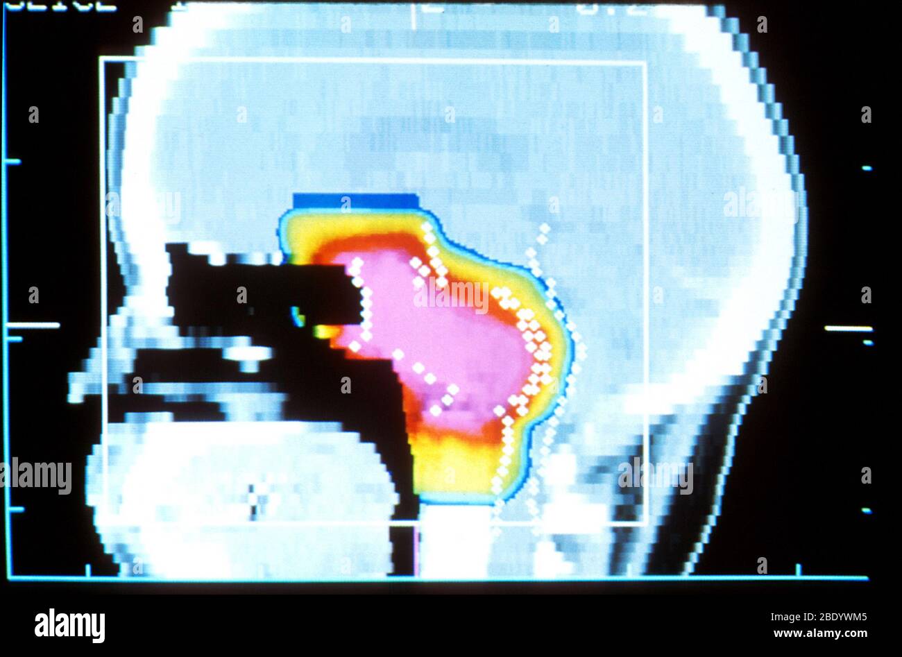 Terapia con fascio protonico Foto Stock