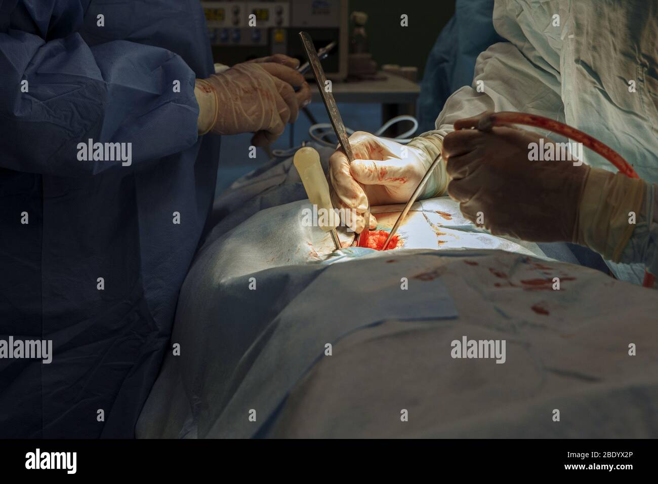 Foto di un'operazione reale sulla spina dorsale. Il chirurgo e l'assistente eseguono il trattamento. Foto Stock
