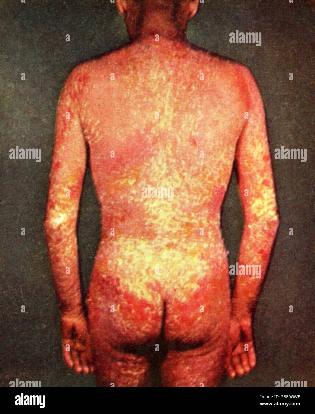 Eritroderma (noto anche come dermatite esfoliativa, dermatite esfoliativa e sindrome dell'uomo rosso), una malattia infiammatoria della pelle, caratterizzata da scalfore che interessa tutto il corpo. Foto Stock
