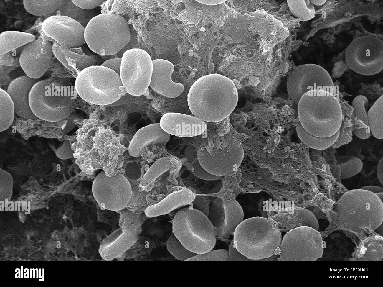 Questa micrografia elettronica a scansione (SEM) raffigurava un certo numero di globuli rossi trovati in mesh in una matrice fibrinosa sulla superficie luminale di un vascolare a permanenza; ingrandito 2849x. In questo caso, il catetere a permanenza era un tubo che è stato lasciato in posizione creando un portale brevettuale direttamente in un vaso sanguigno. Si noti la forma citomorfologica biconcava di ciascun eritrocita, che aumenta l'area superficiale di queste cellule riempite di emoglobina, promuovendo così un maggiore grado di scambio di gas, che è la loro funzione primaria in un ambiente in vivo. Nella loro fase adulta, queste cellule non possiedono nucleu Foto Stock