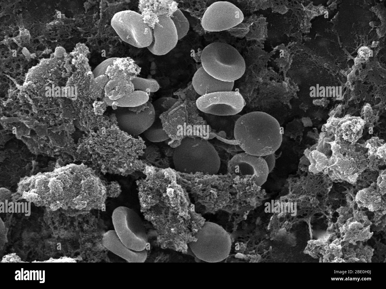 Questa micrografia elettronica a scansione (SEM) raffigurava un certo numero di globuli rossi trovati in mesh in una matrice fibrinosa sulla superficie luminale di un catetere vascolare a permanenza; 2858x ingrandito notare la forma citomorfologica biconcava di ciascun eritrocita, che aumenta l'area superficiale di queste cellule riempite di emoglobina, promuovendo così un maggiore grado di scambio di gas, che è la loro funzione primaria in un ambiente in vivo. Nella loro fase adulta, queste cellule non possiedono alcun nucleo. Quello che sembra essere pezzi di detriti di forma irregolare, sono in realtà grumi di fibrina, che quando all'interno degli organis viventi Foto Stock