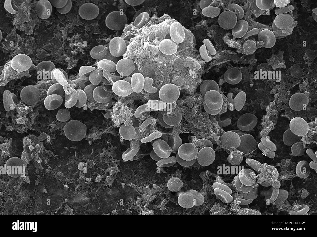 Questa micrografia elettronica a scansione (SEM) raffigurava un certo numero di globuli rossi trovati in mesh in una matrice fibrinosa sulla superficie luminale di un vascolare a permanenza; ingrandito 1425x. In questo caso, il catetere a permanenza era un tubo che è stato lasciato in posizione creando un portale brevettuale direttamente in un vaso sanguigno. Si noti la forma citomorfologica biconcava di ciascun eritrocita, che aumenta l'area superficiale di queste cellule riempite di emoglobina, promuovendo così un maggiore grado di scambio di gas, che è la loro funzione primaria in un ambiente in vivo. Nella loro fase adulta, queste cellule non possiedono nucleu Foto Stock