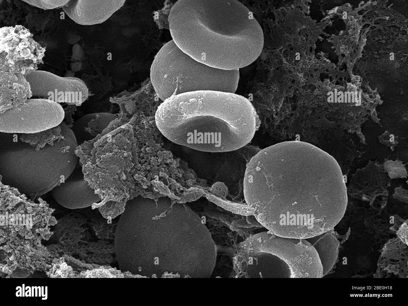 Questa micrografia elettronica a scansione (SEM) raffigurava un certo numero di globuli rossi trovati in mesh in una matrice fibrinosa sulla superficie luminale di un catetere vascolare a permanenza; Ingrandito 5716x notare la forma citomorfologica biconcava di ciascun eritrocita, che aumenta l'area superficiale di queste cellule riempite di emoglobina, promuovendo così un maggiore grado di scambio di gas, che è la loro funzione primaria in un ambiente in vivo. Nella loro fase adulta, queste cellule non possiedono alcun nucleo. Quello che sembra essere pezzi di detriti di forma irregolare, sono in realtà grumi di fibrina, che quando all'interno degli organis viventi Foto Stock