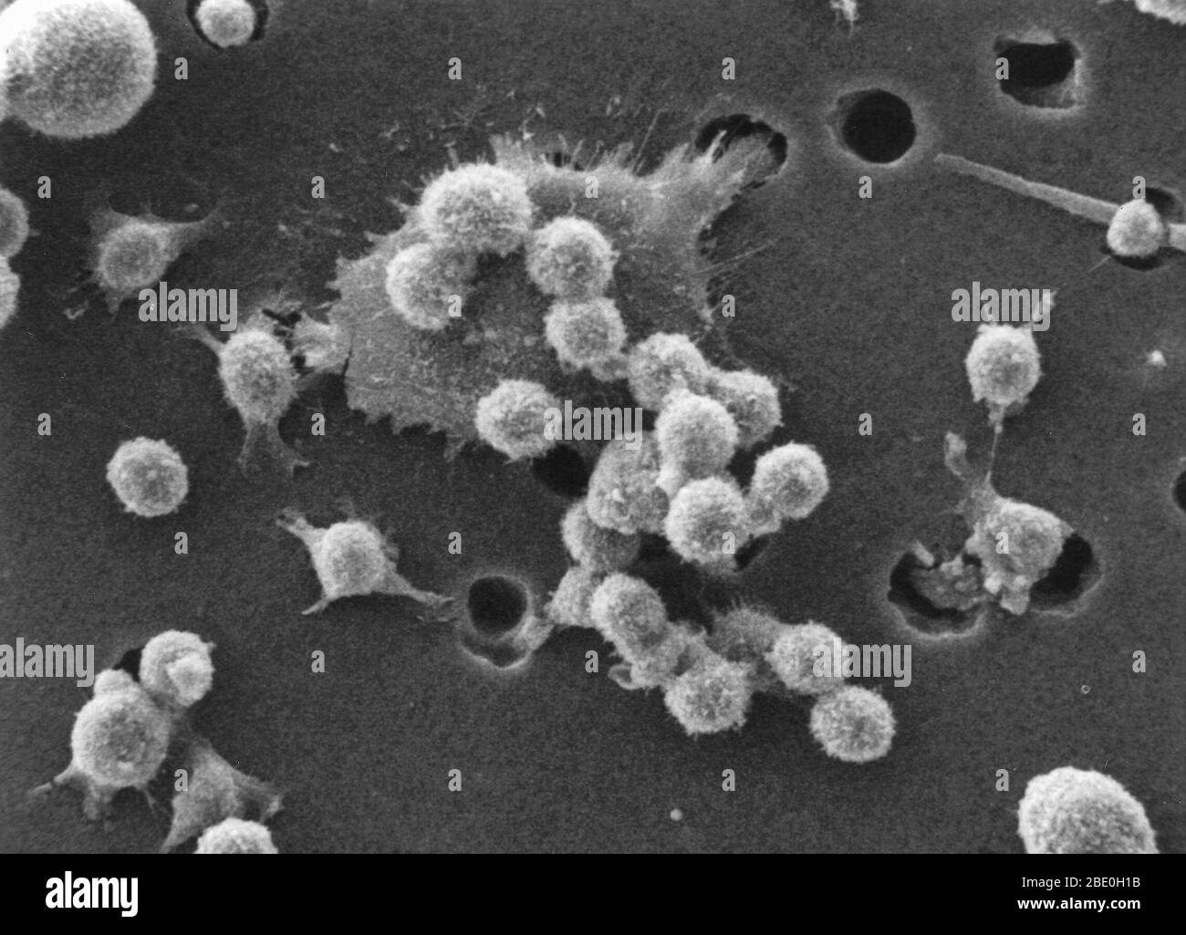 Fase due di una sequenza a sei fasi della morte di una cellula tumorale. Un buffy coat contenente globuli rossi, linfociti e macrofagi viene aggiunto al fondo della membrana. Un gruppo di macrofagi identifica la cellula di cancro come materia estranea e comincia ad attaccarsi alla cellula di cancro, che ancora ha i relativi picchi. Ingrandimento foto: 4000x Foto Stock