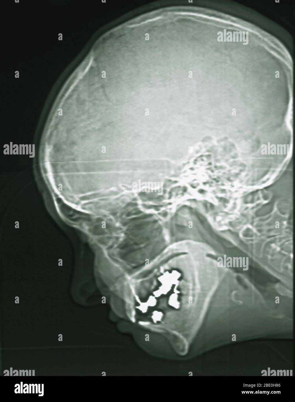 MRI che mostra i seni di una donna di 54 anni. MRI è normale. Foto Stock
