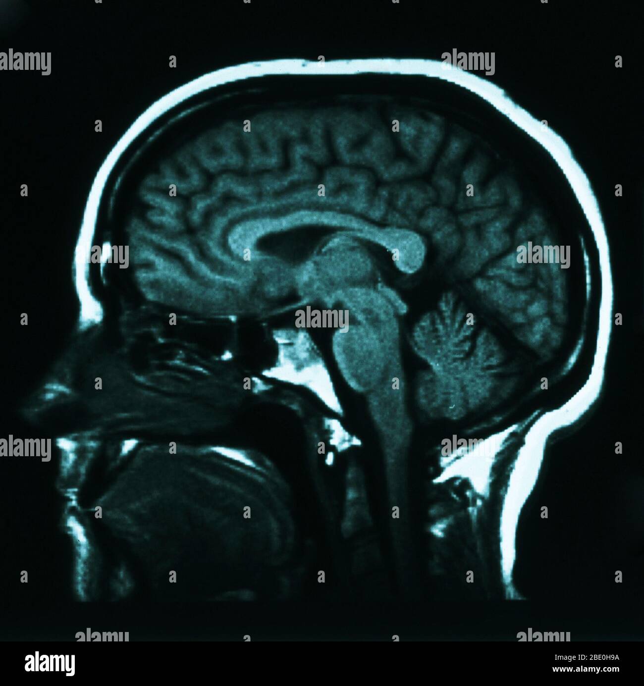 MRI sagittale (dal lato) pesato in T1 che mostra l'anatomia normale del cervello, inclusi: Corteccia cerebrale, corpus calloso, talamo, medulla oblonata, cervelletto e tronco cerebrale. Foto Stock