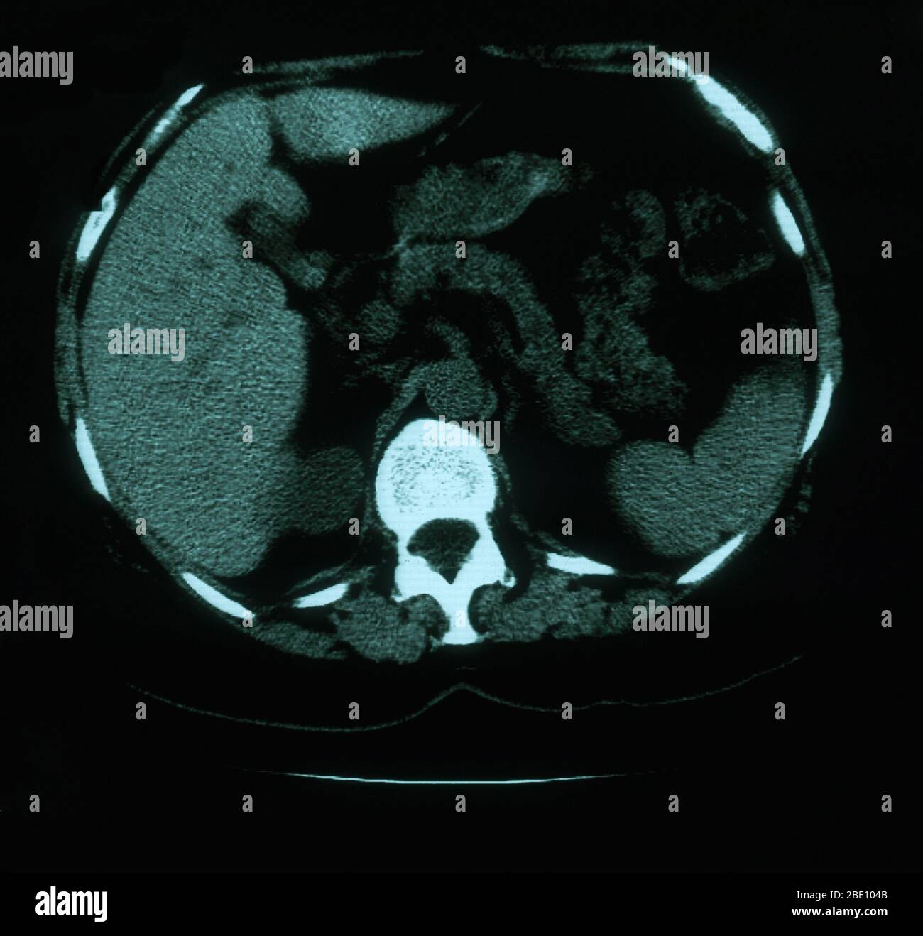 Un'immagine TC assiale (in sezione trasversale) attraverso i polmoni di una femmina di 53 anni. La scansione mostra la tortuosità e la prominenza della vascolatura nel mediastino superiore destro. Sono presenti anche noduli esili calcificati sinistri e calcificazioni multiple di puntato in tutta la milza che sono coerenti con il granuloma. Foto Stock