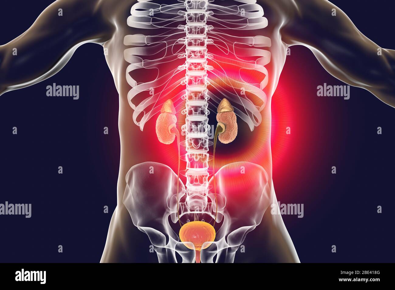 Malattia renale cronica. Illustrazione computerizzata che mostra l'anatomia grossolana dei reni con glomerulonefrite cronica. I reni sono atrofizzati con una corteccia sottile e cisti che creano un aspetto irregolare. La forma cronica di glomerulonefrite può svilupparsi negli adulti in seguito a infezione da streptococco alla gola. È clinicamente considerato come bassa produzione di urina (oliguria), pressione sanguigna alta e ritenzione di urea. Foto Stock