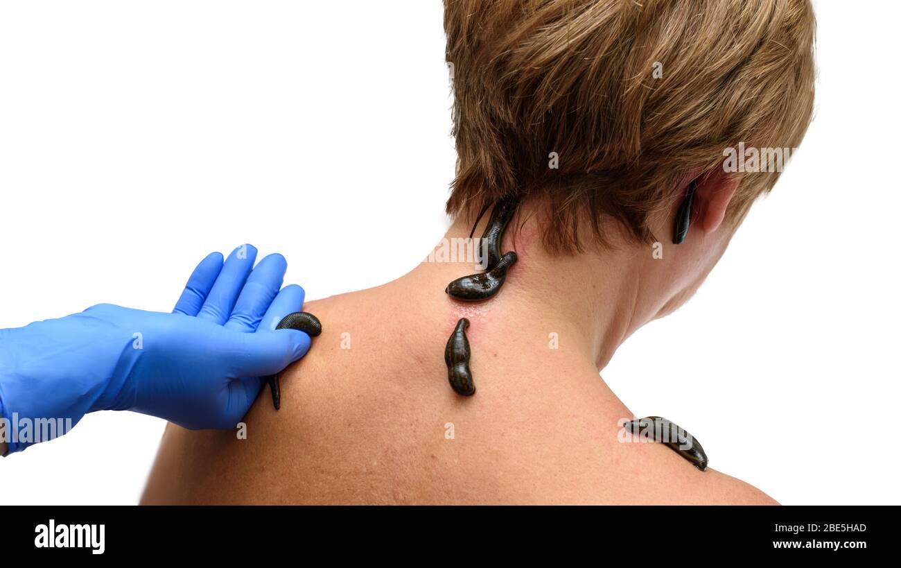 Sangue che succhia i leechs hirudo medicinalis sulla testa e sulle spalle della donna. Il guanto blu a mano tiene un guanto Foto Stock