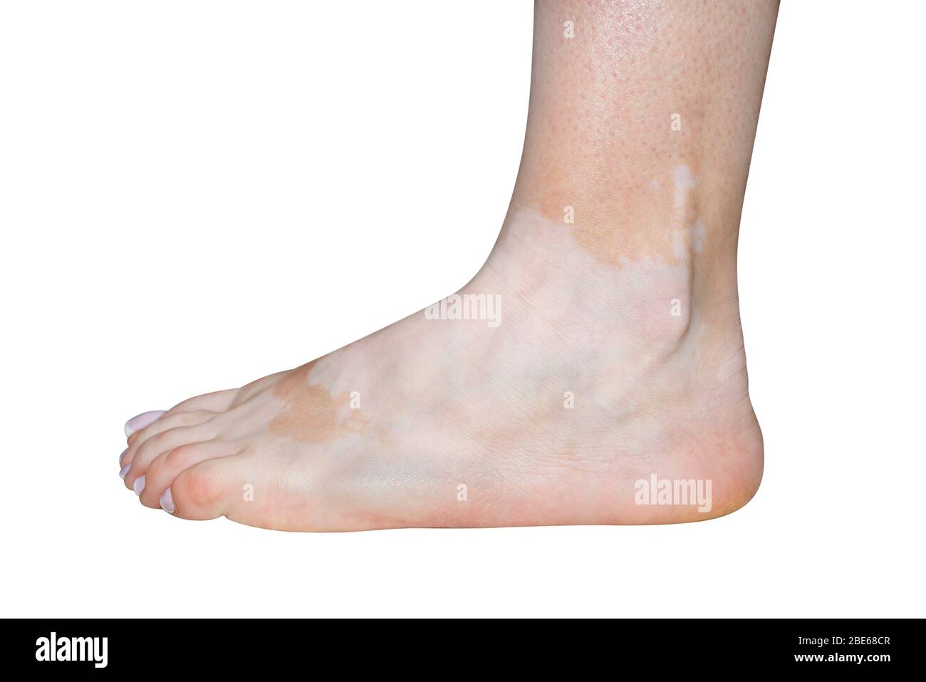 Macchie di malattia di vitiligo sul piede sinistro in una giovane donna caucasica, isolata su sfondo bianco con un sentiero di taglio. Foto Stock