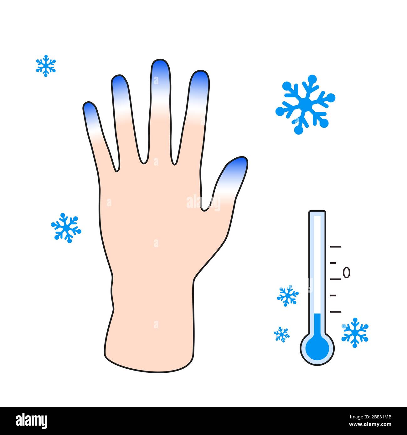 Congelamento. Mano con sintomi di congelamento effetto del freddo sulle dita umane. Vettore Illustrazione Vettoriale