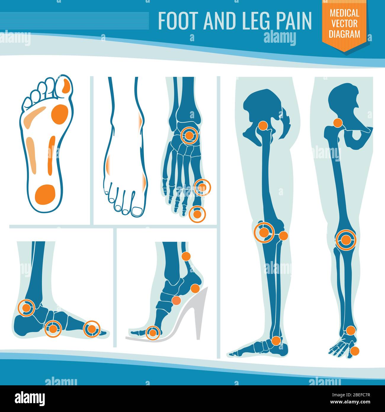 Dolore ai piedi e alle gambe. Artrite e reumatismo diagramma vettoriale medico ortopedico. Illustrazione dell'articolazione delle gambe reumatismi Illustrazione Vettoriale