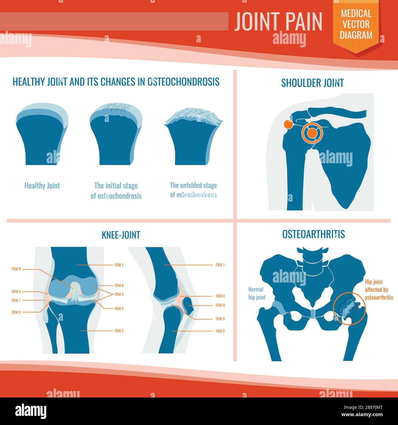 Osteoartrite e reumatismo dolore articolare infografica su vettore medico. Artrite e reumatismi, osteoartrite, ortopedica medica Illustrazione Vettoriale