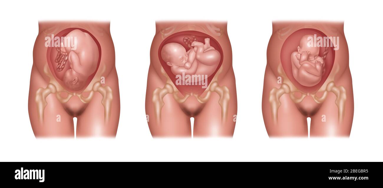 Posizioni del feto in utero, illustrazione Foto Stock