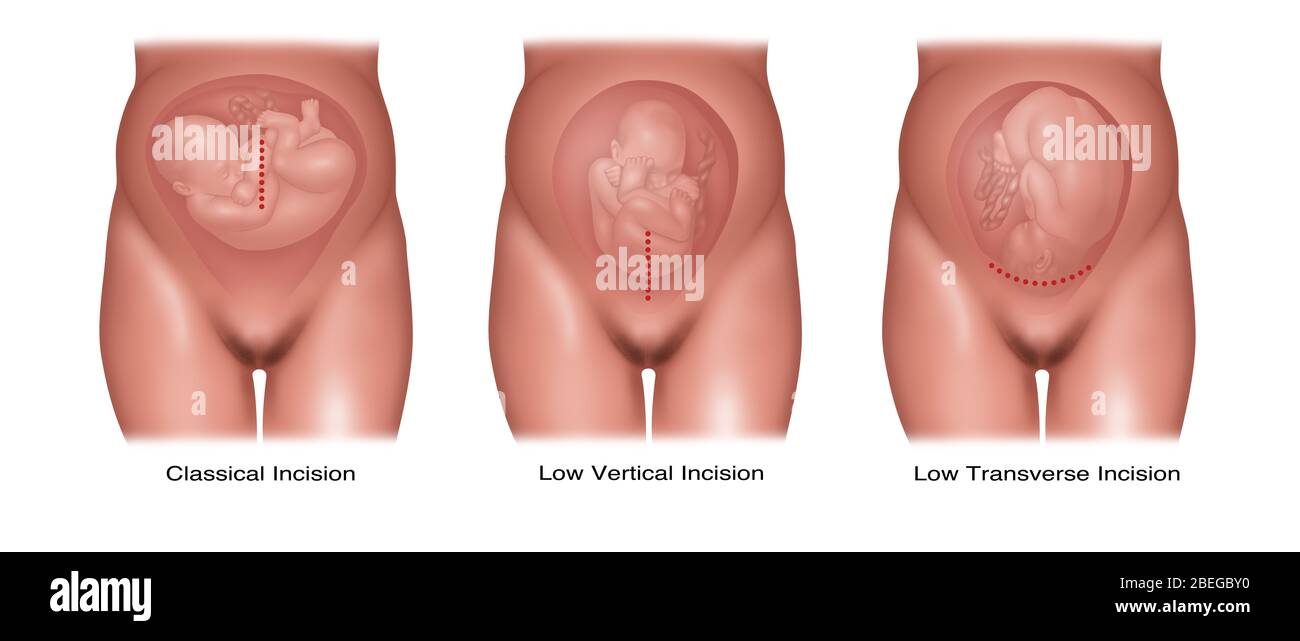 Tipi di incisione Cesarean, illustrazione Foto Stock