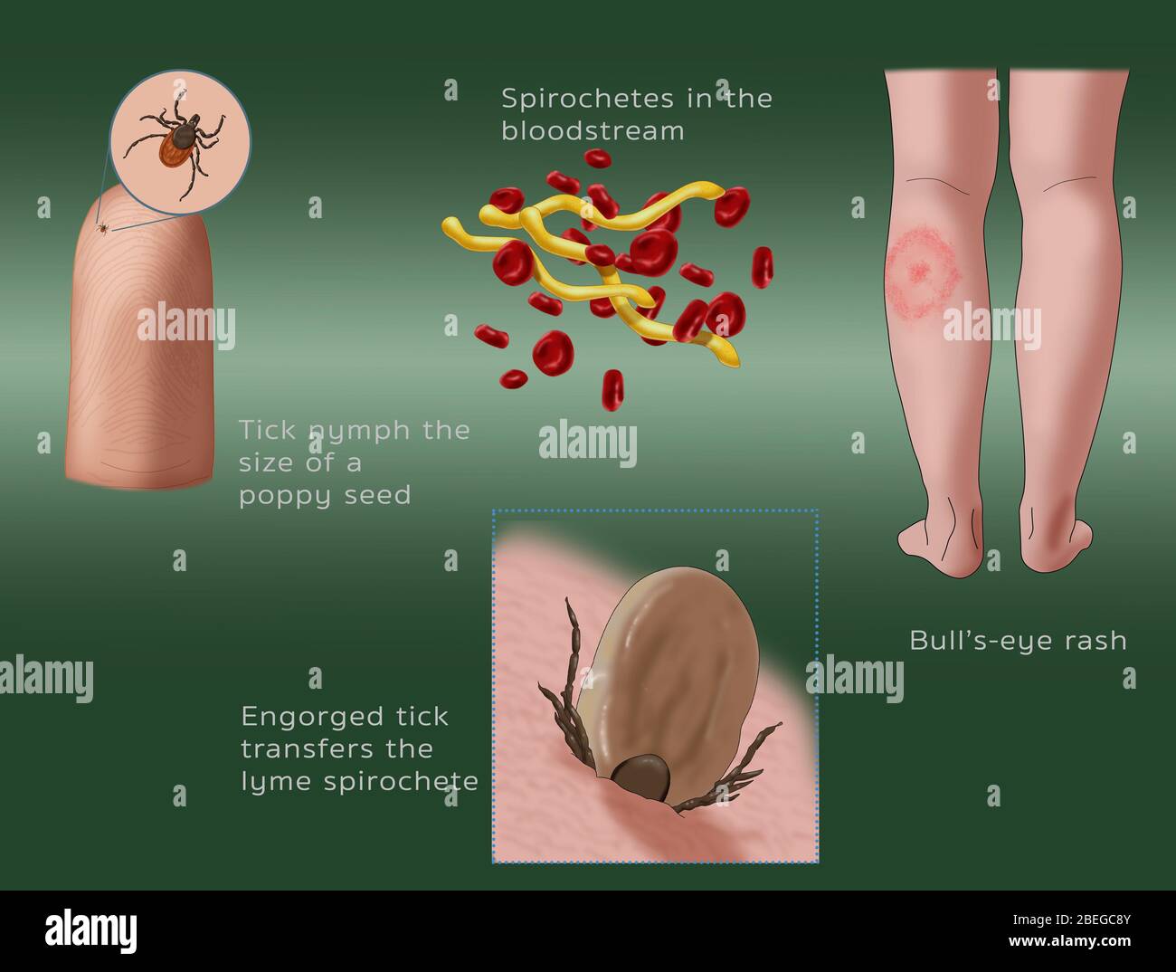 Ciclo di infezione da malattia di Lyme, illustrazione Foto Stock