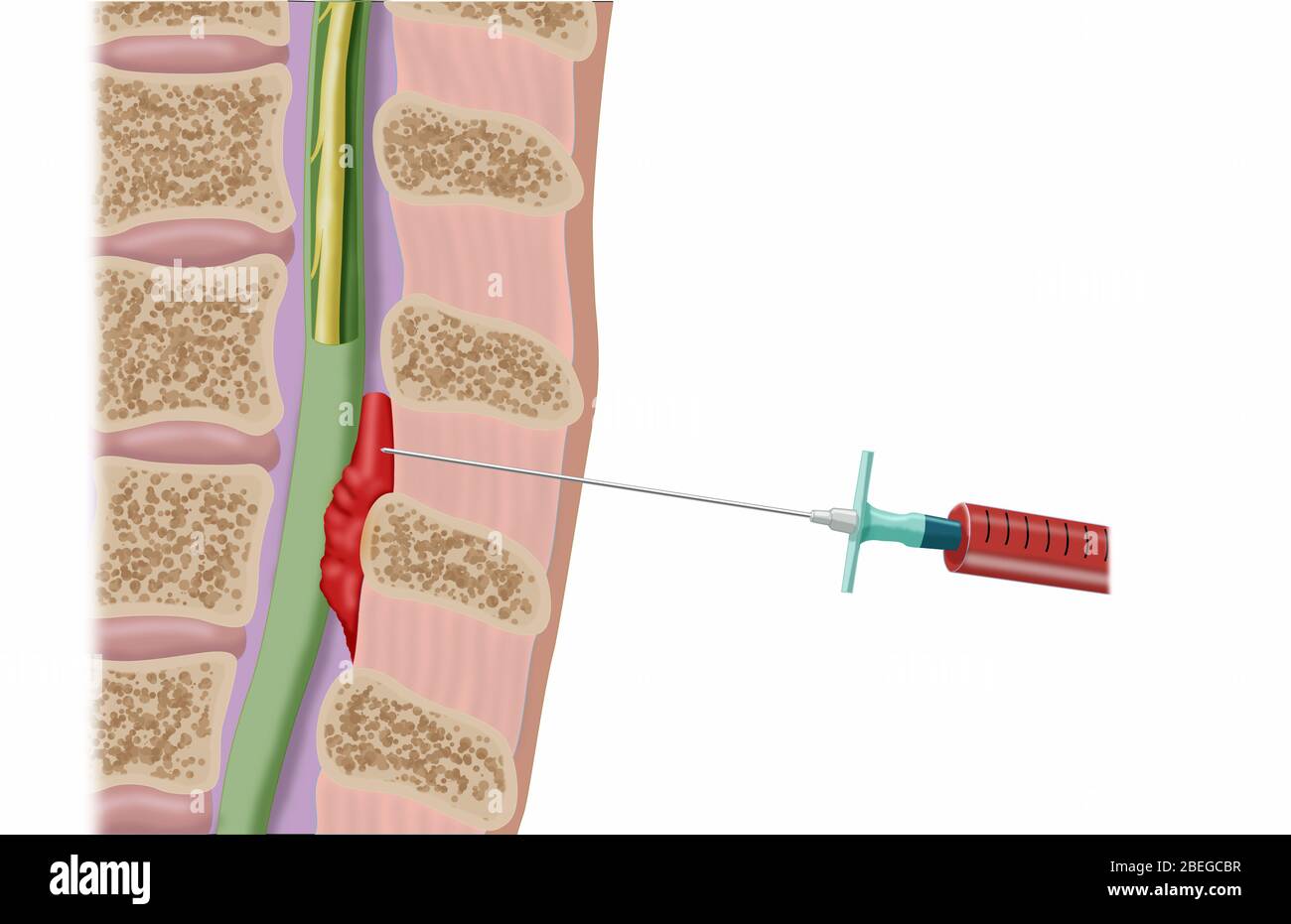 Procedura epidurale del cerotto ematico, illustrazione Foto Stock