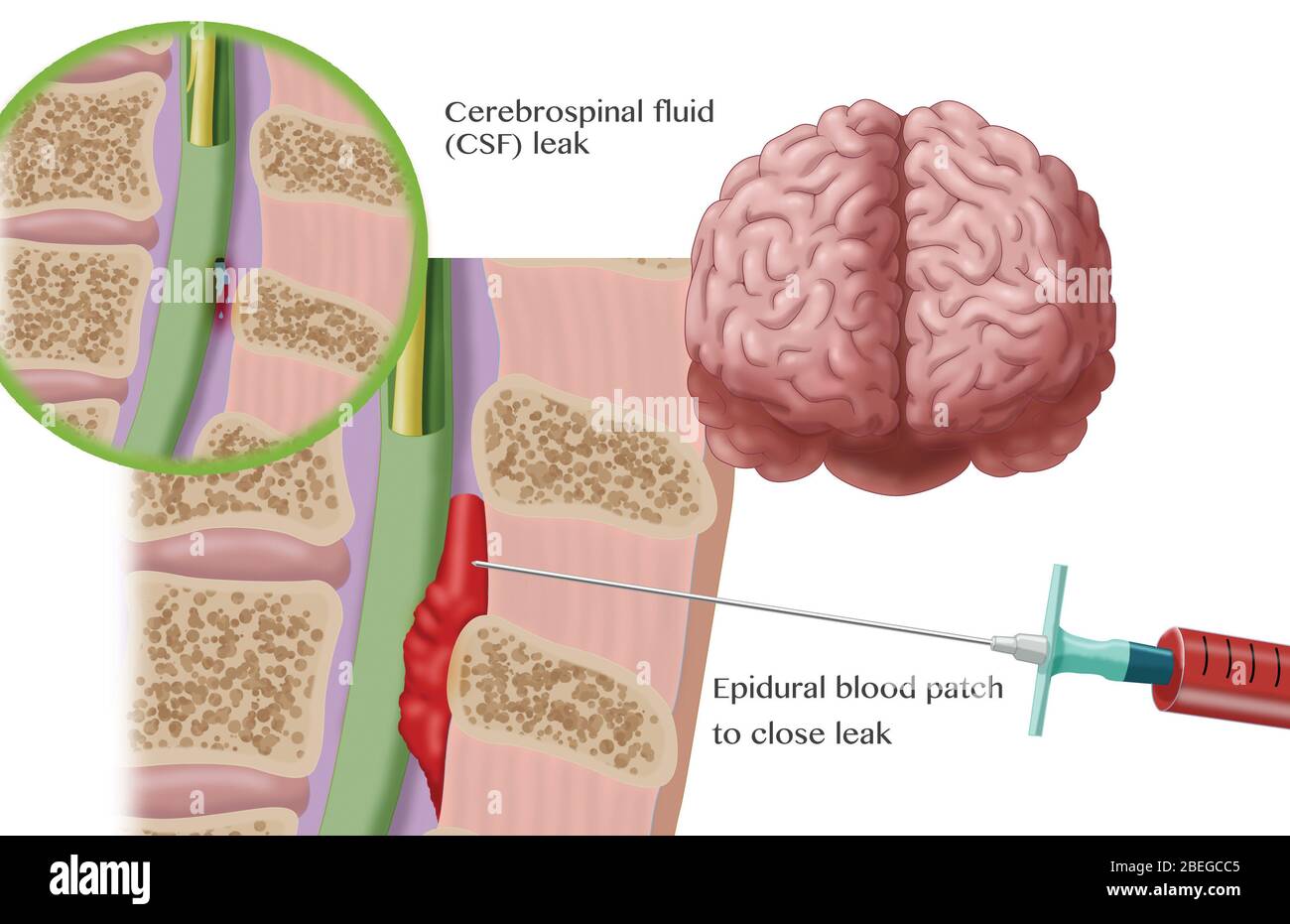 Procedura epidurale del cerotto ematico, illustrazione Foto Stock