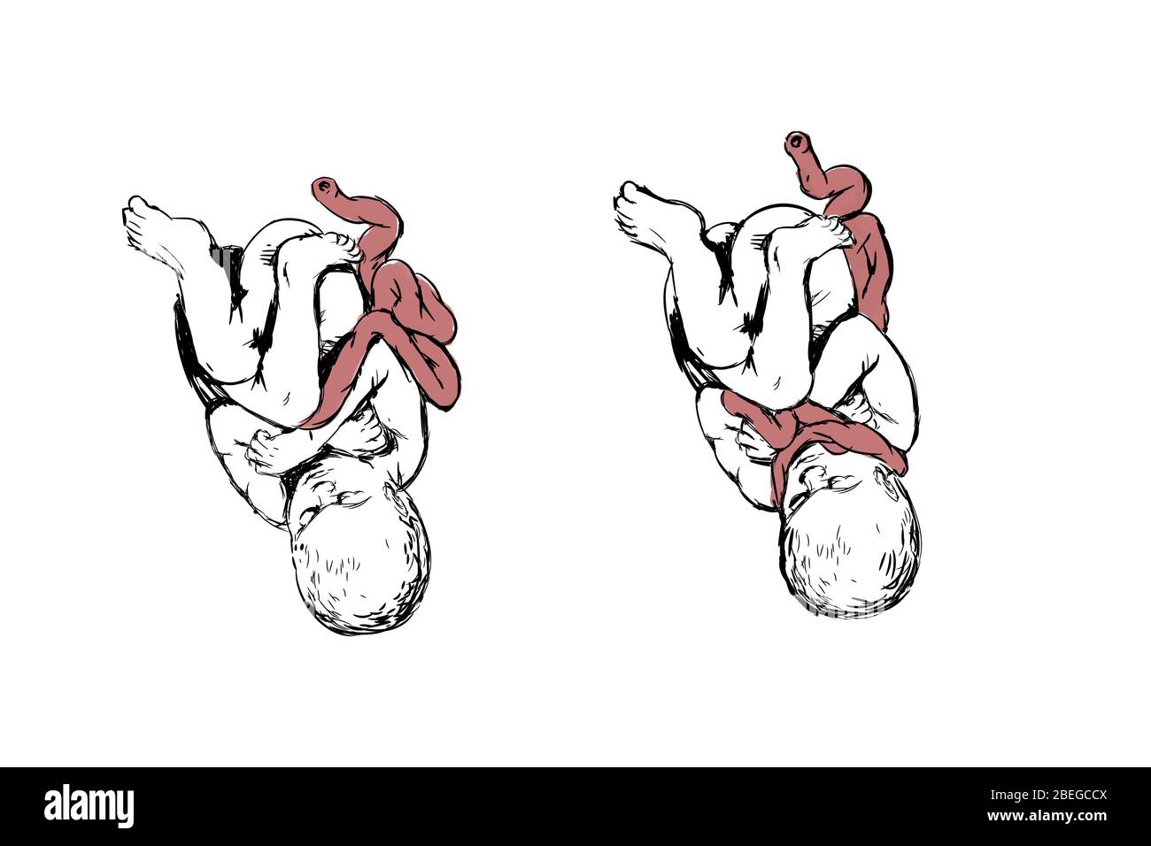 Illustrazione che mostra un bambino con il cavo nuchal (il cavo ombelicale avvolto intorno al collo), una condizione che può potenzialmente causare complicazioni alla nascita, come asfissia. Foto Stock