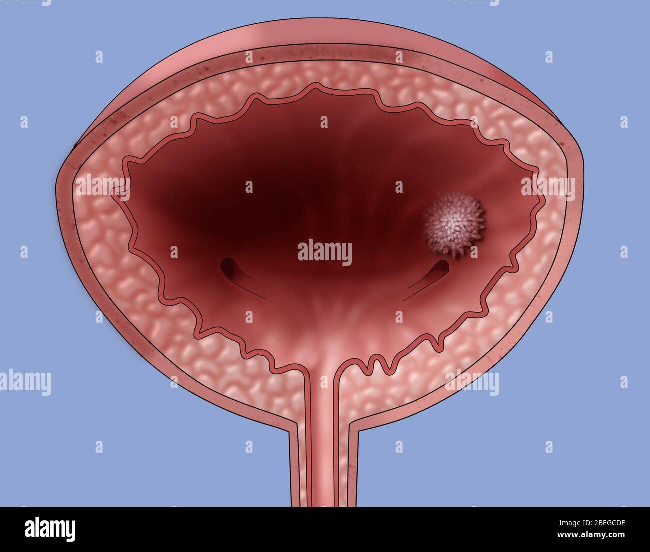 Cancro della vescica, illustrazione Foto Stock