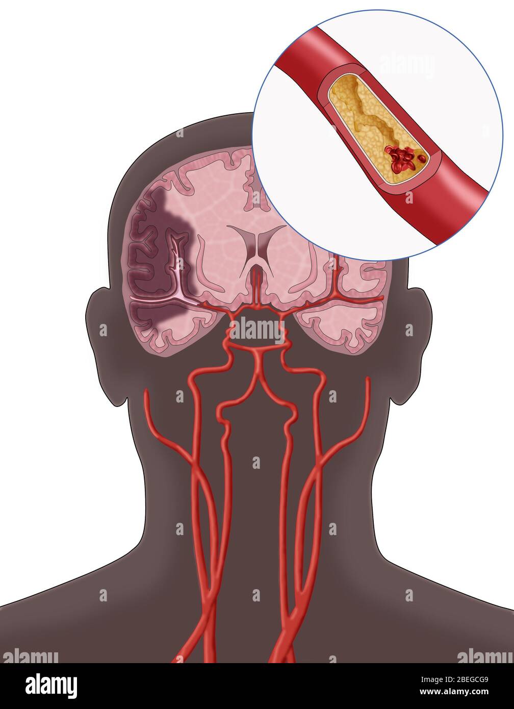 Ictus ischemico, illustrazione Foto Stock