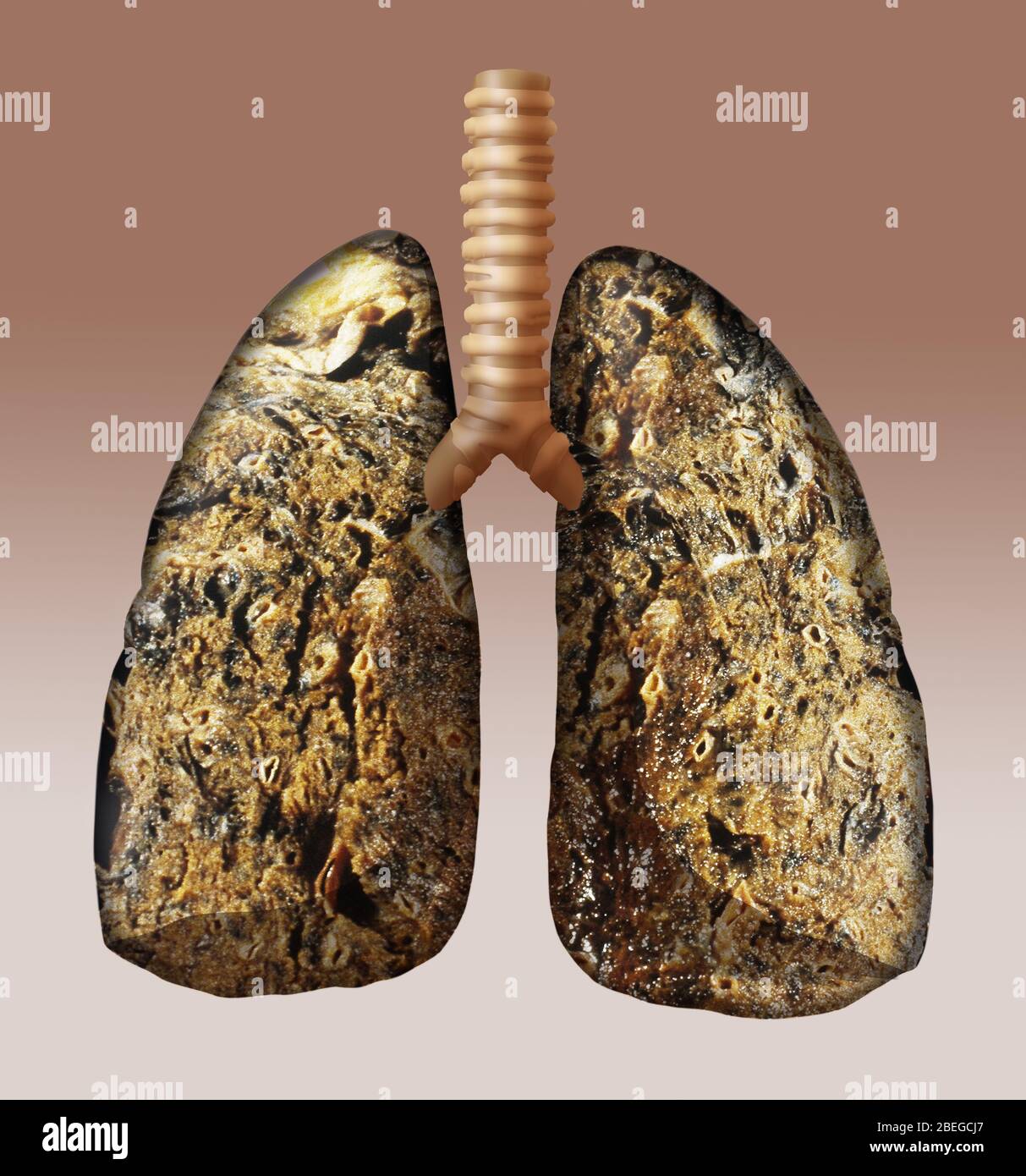 Polmone dei fumatori immagini e fotografie stock ad alta risoluzione - Alamy