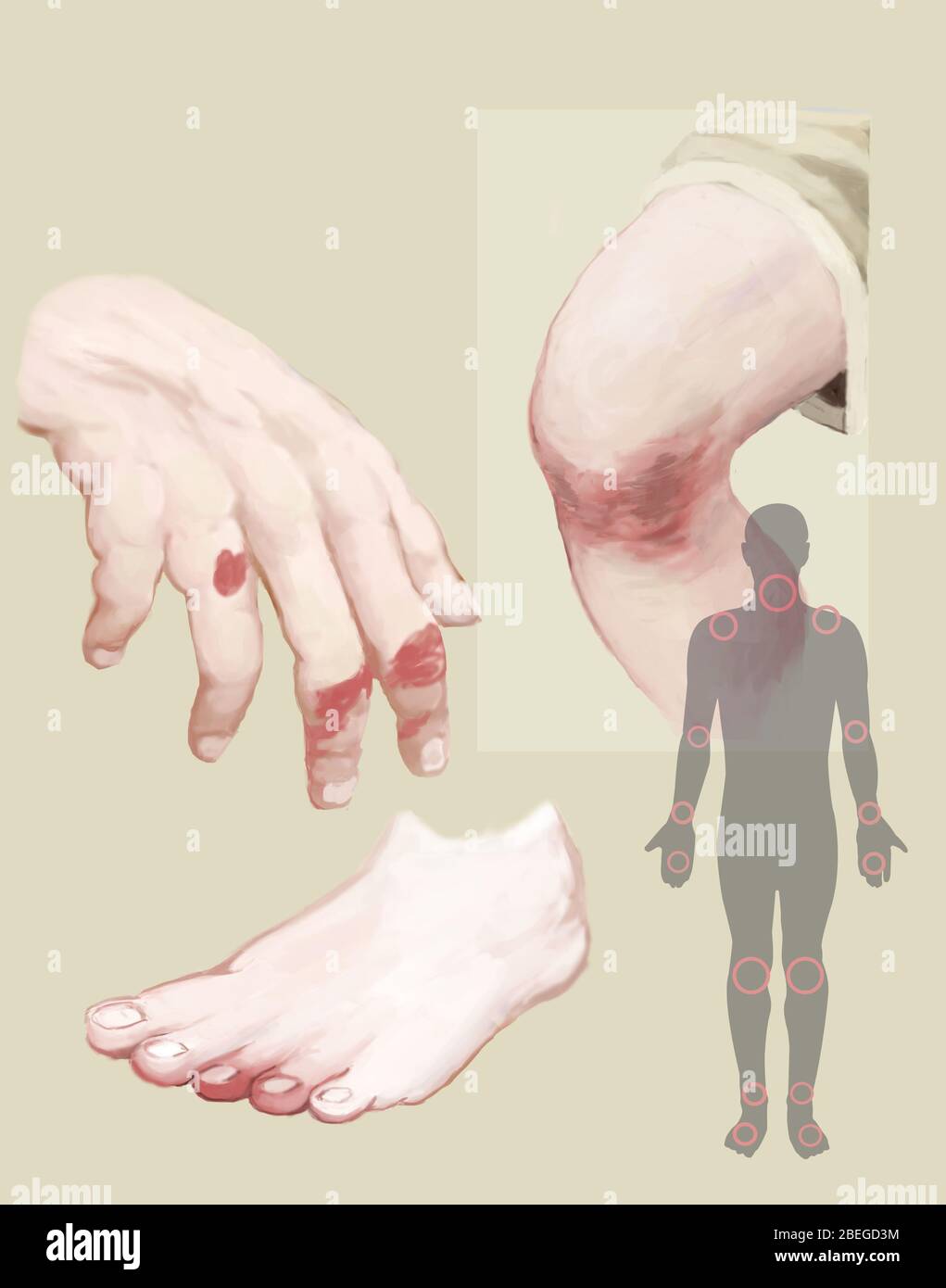 Psoriasi, illustrazione Foto Stock