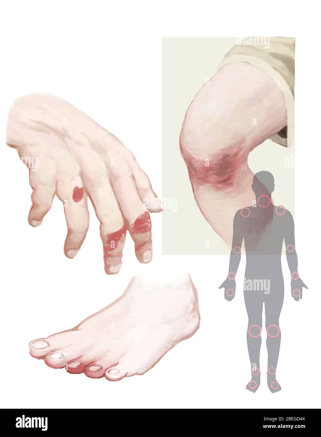 Illustrazione della psoriasi. Foto Stock