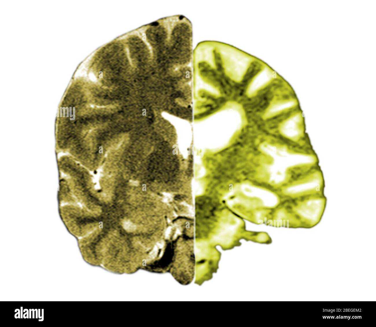 MRI cerebrali normali e di Alzheimer Foto Stock