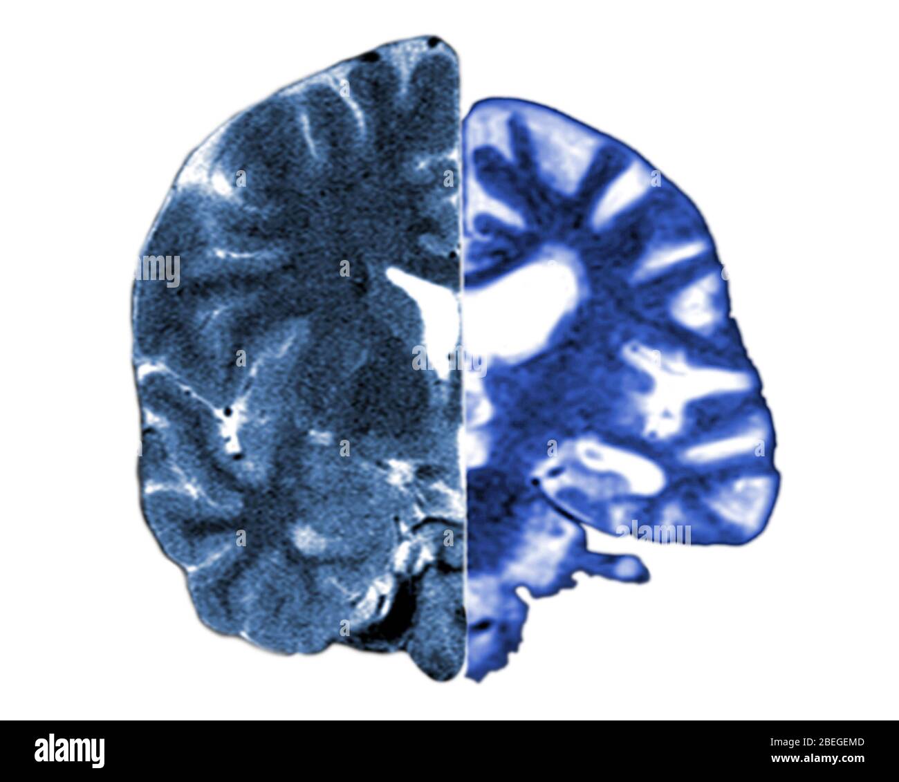 MRI cerebrali normali e di Alzheimer Foto Stock