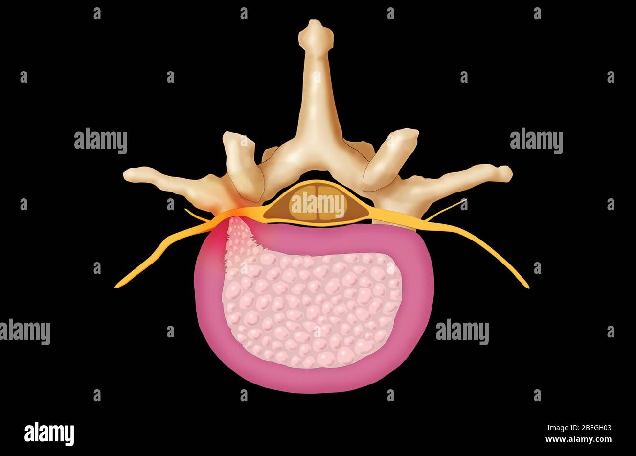 Vertebra lombare e disco erniato Foto Stock