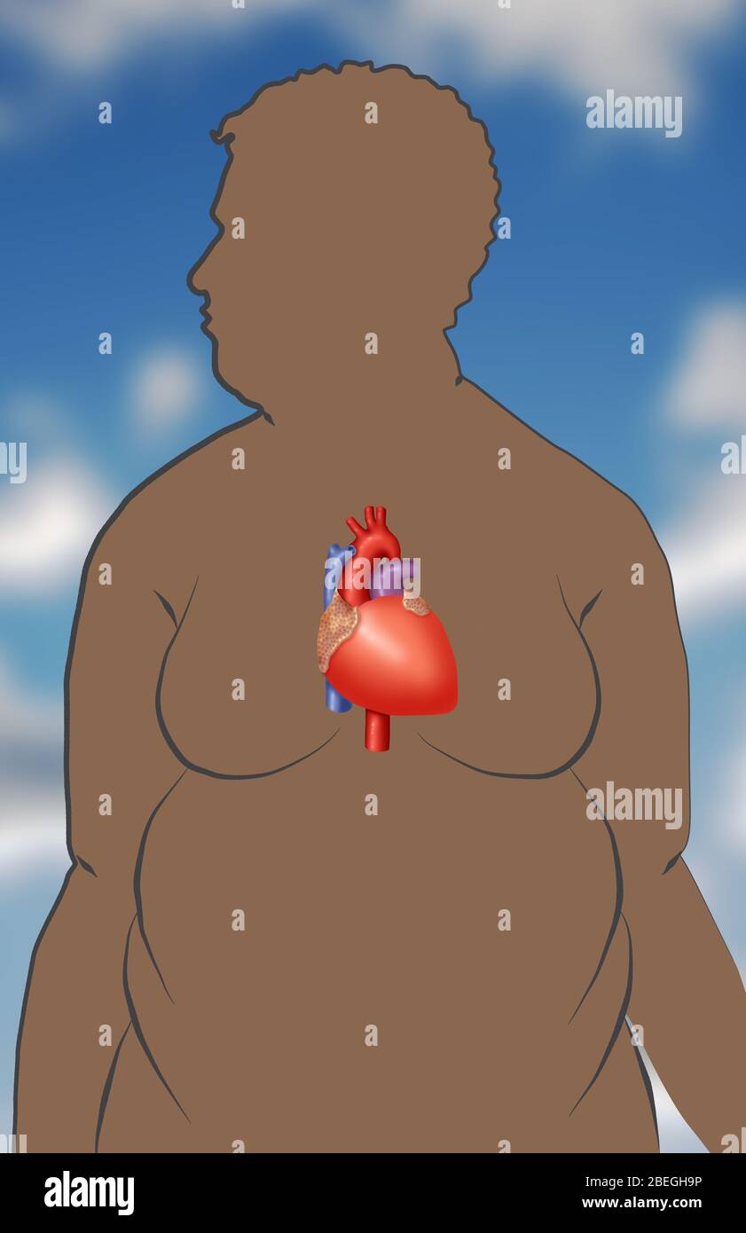 L'obesità aumenta il rischio di malattie cardiache Foto Stock