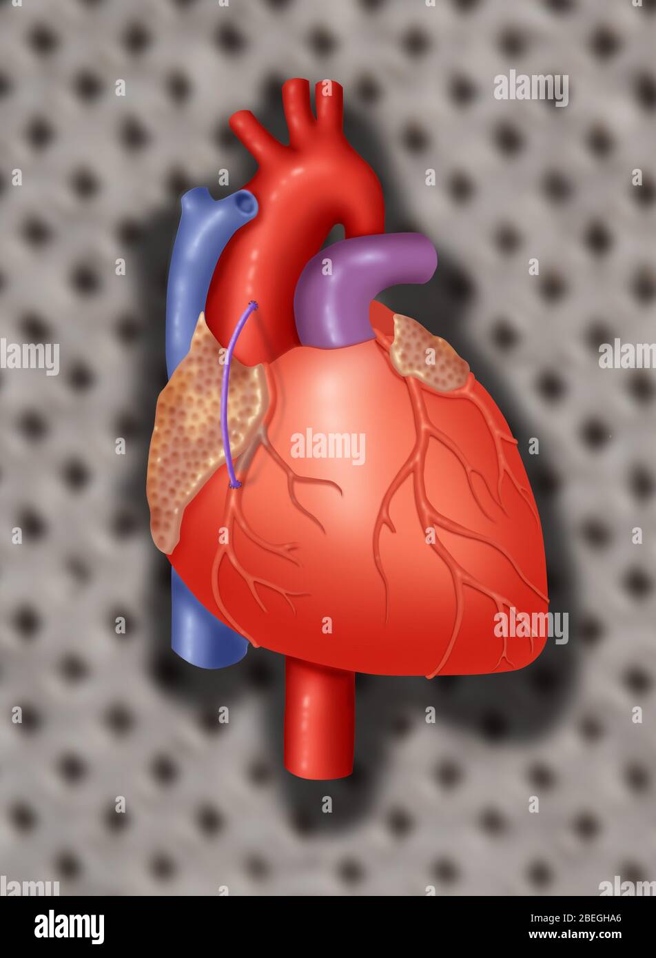 Trapianto di vena coronarica Foto Stock