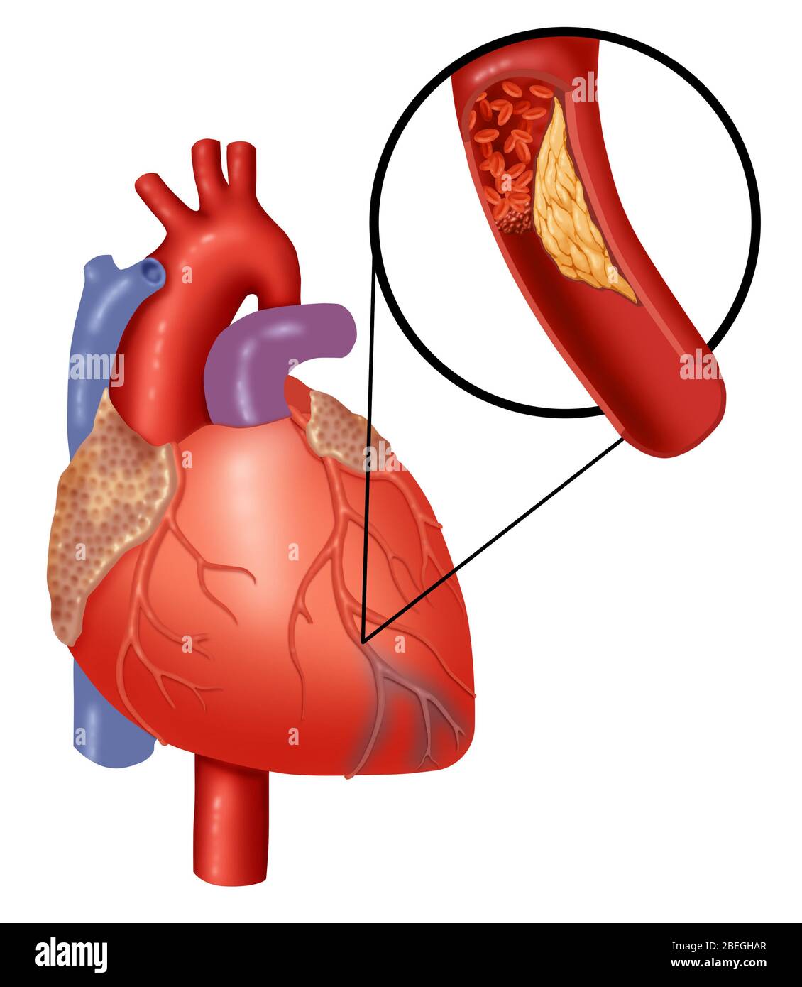 Attacco cardiaco che mostra coagulo di sangue Foto Stock