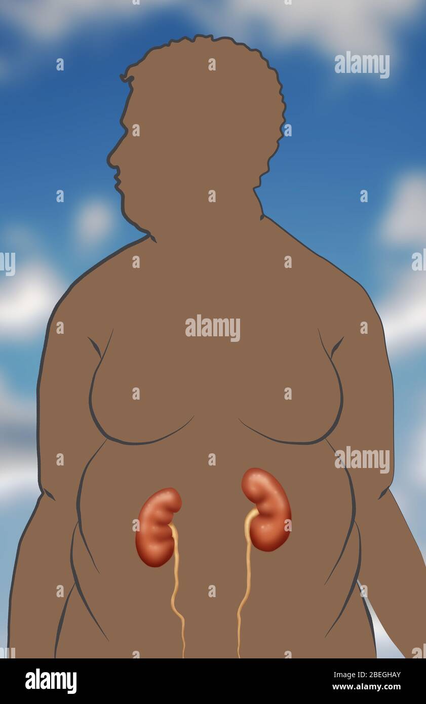 L'obesità aumenta il rischio di malattie renali Foto Stock