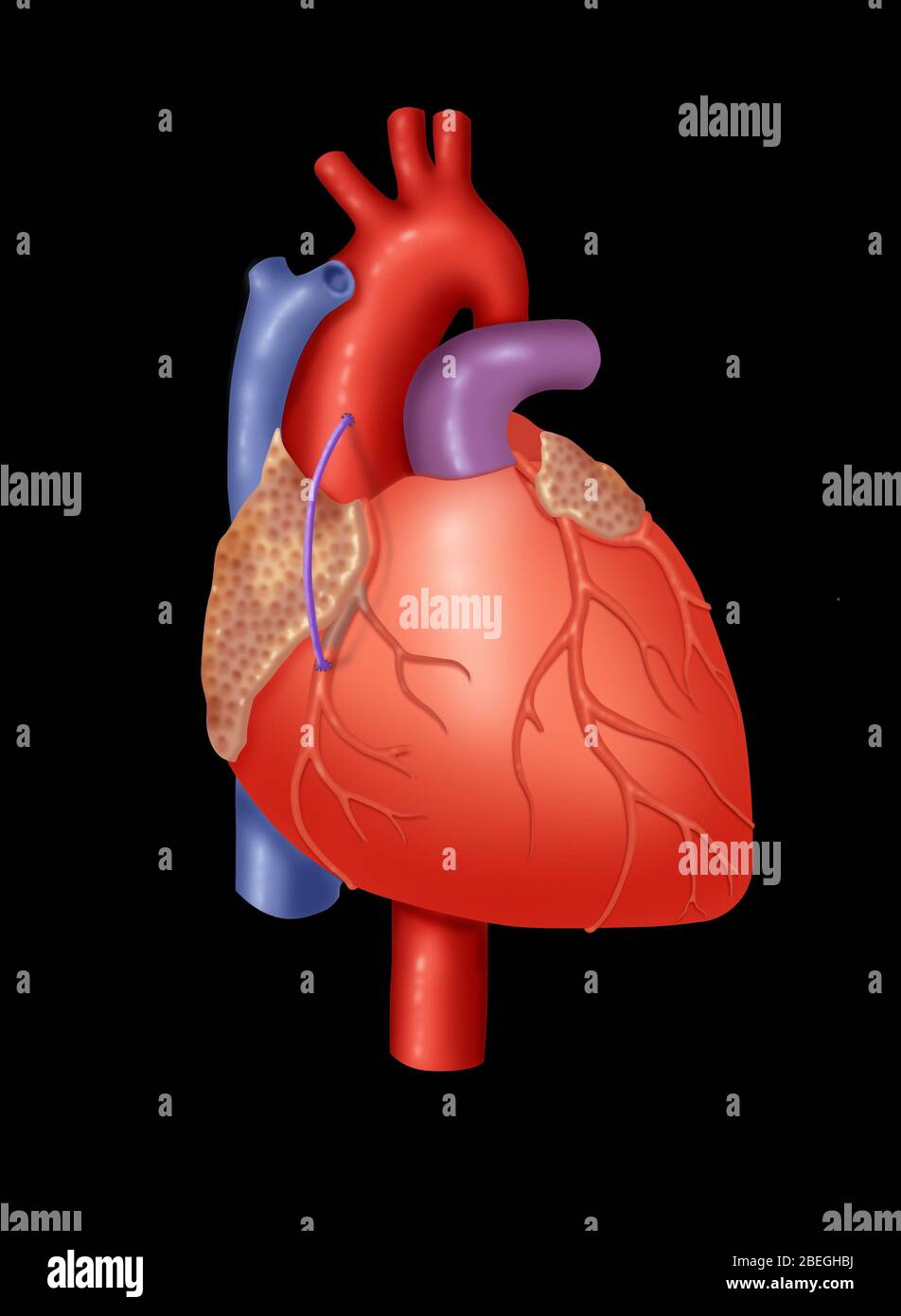 Trapianto di vena coronarica Foto Stock
