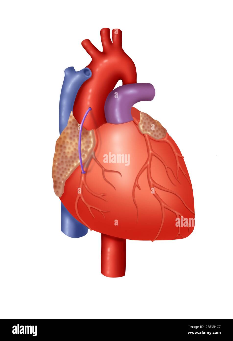 Trapianto di vena coronarica Foto Stock