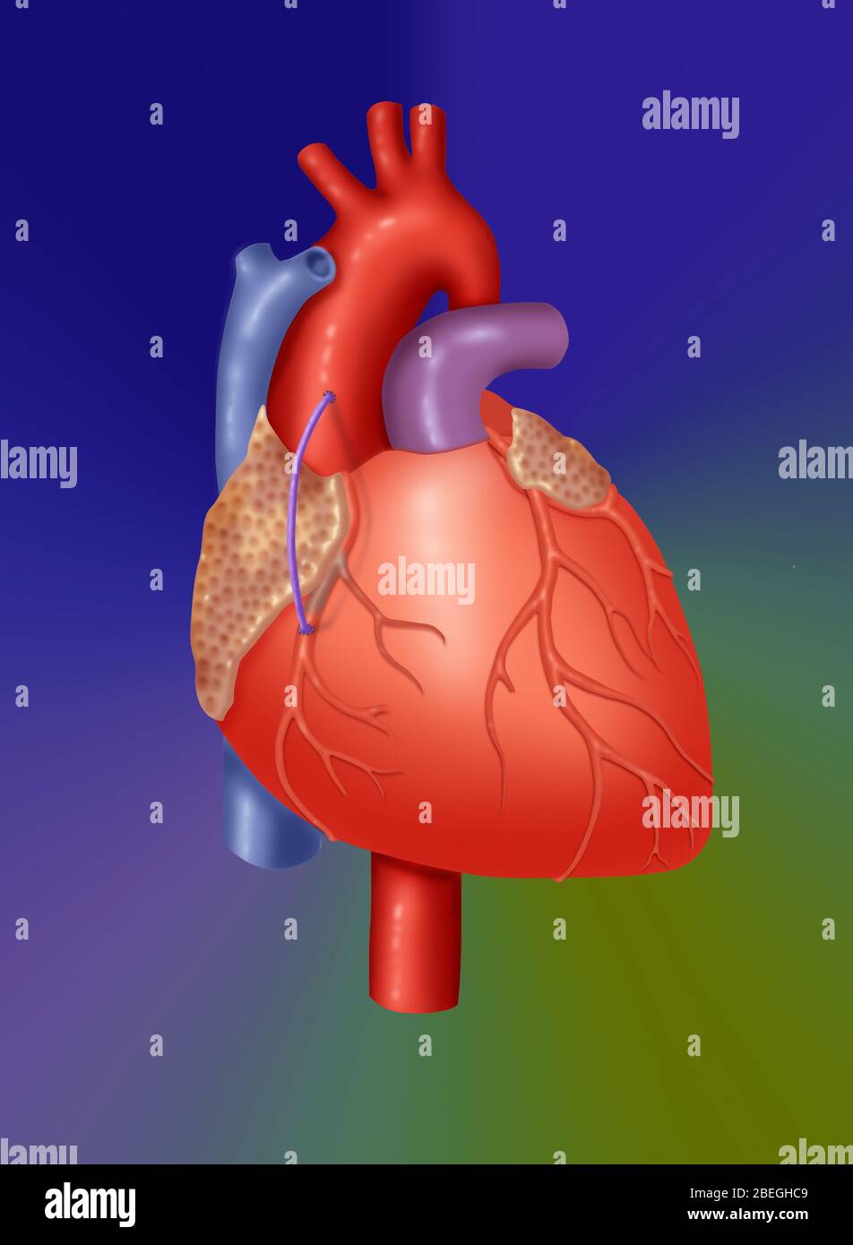 Trapianto di vena coronarica Foto Stock