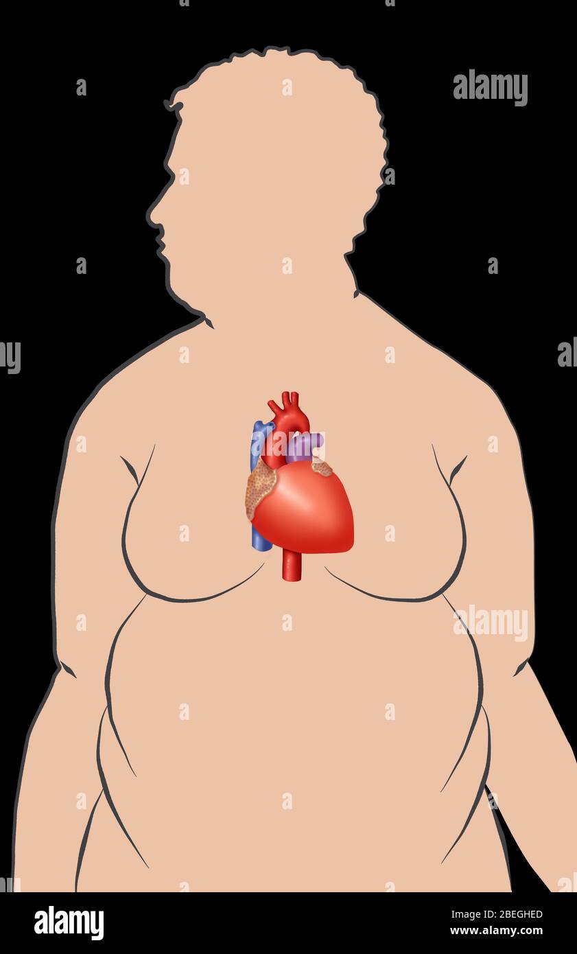 L'obesità aumenta il rischio di malattie cardiache Foto Stock