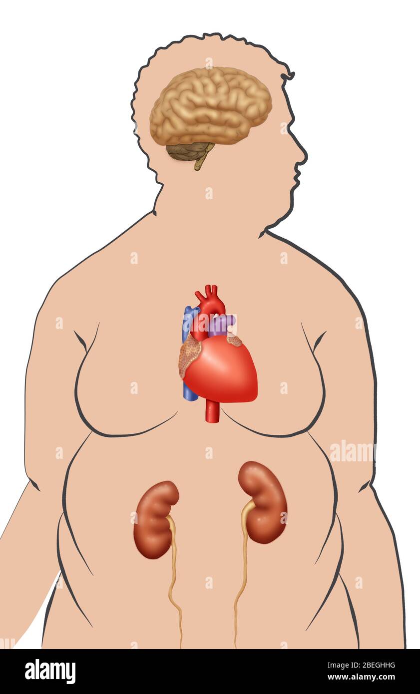 Principali fattori di rischio di obesità Foto Stock