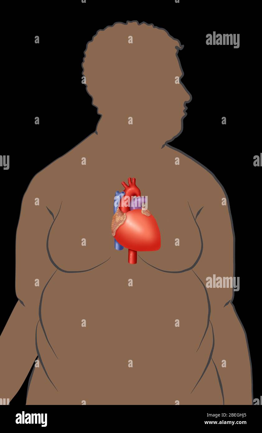 L'obesità aumenta il rischio di malattie cardiache Foto Stock