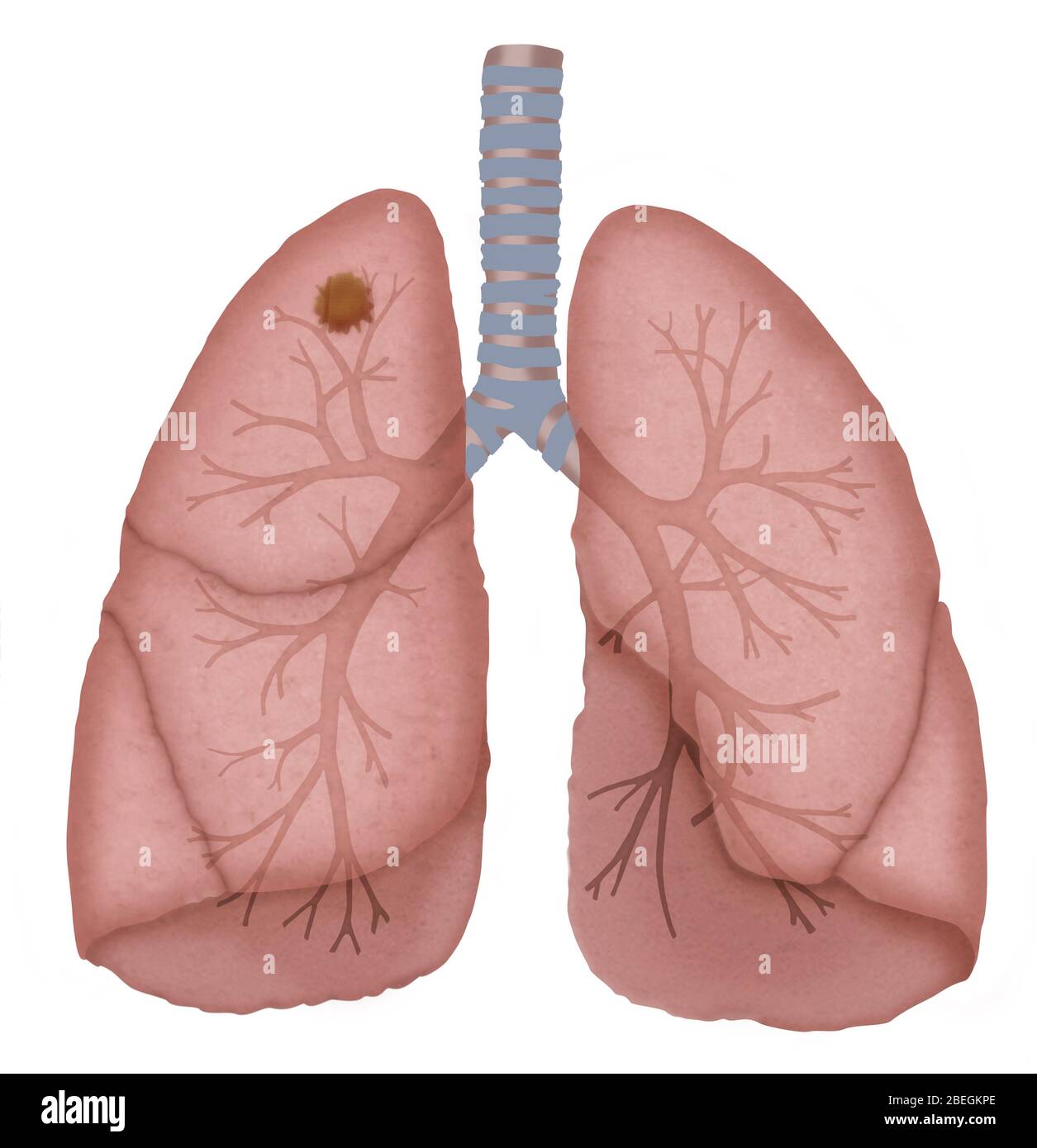 Cancro del polmone Foto Stock