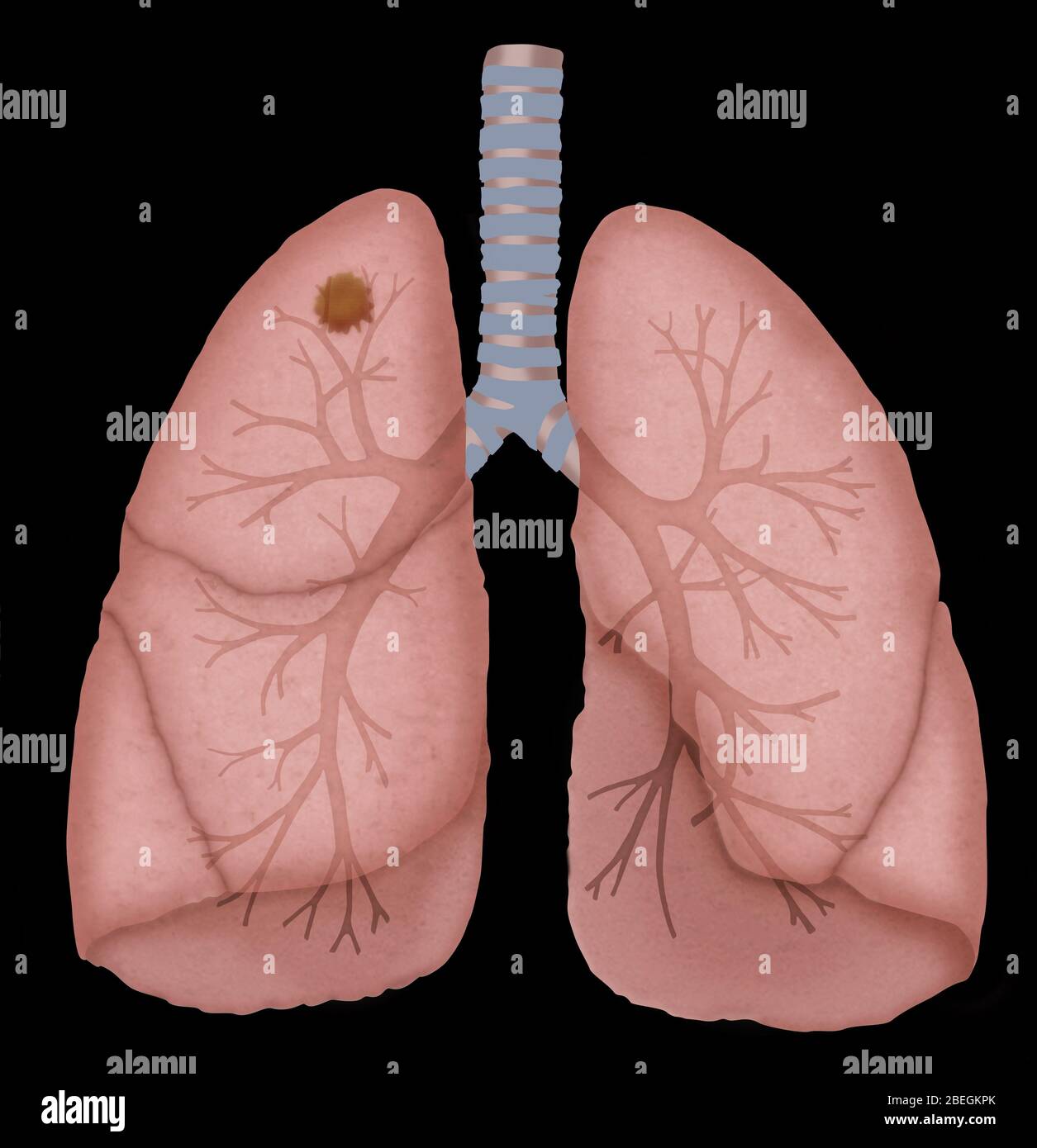 Cancro del polmone Foto Stock
