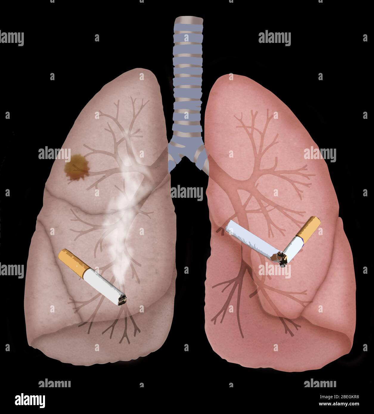 Polmoni sani e cancerosi Foto Stock