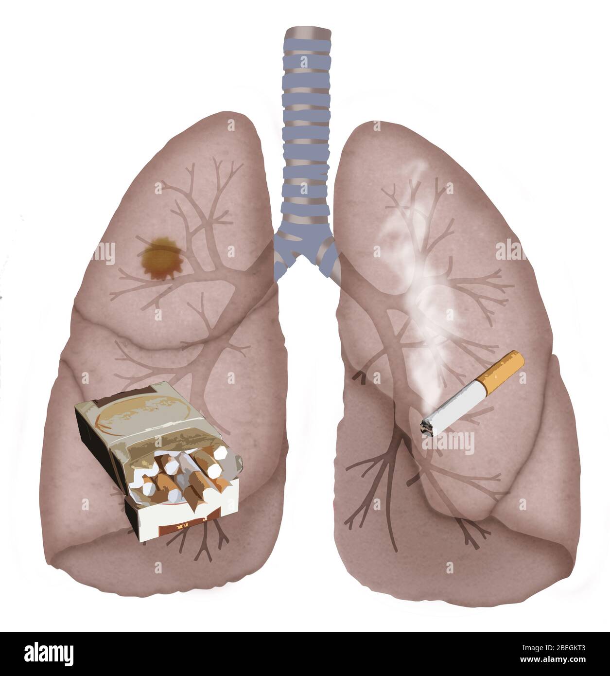 Cancro del polmone Foto Stock