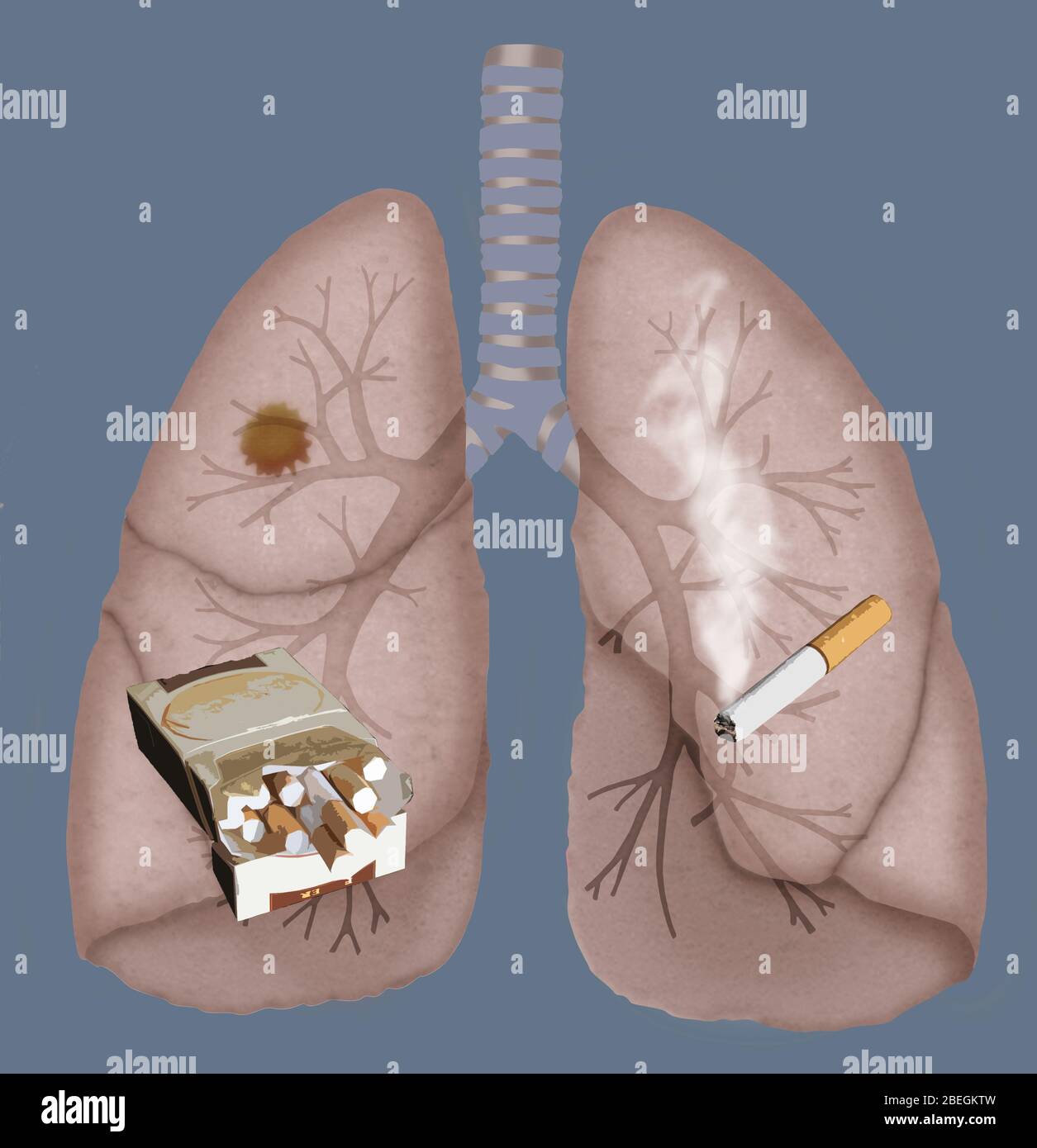 Cancro del polmone Foto Stock