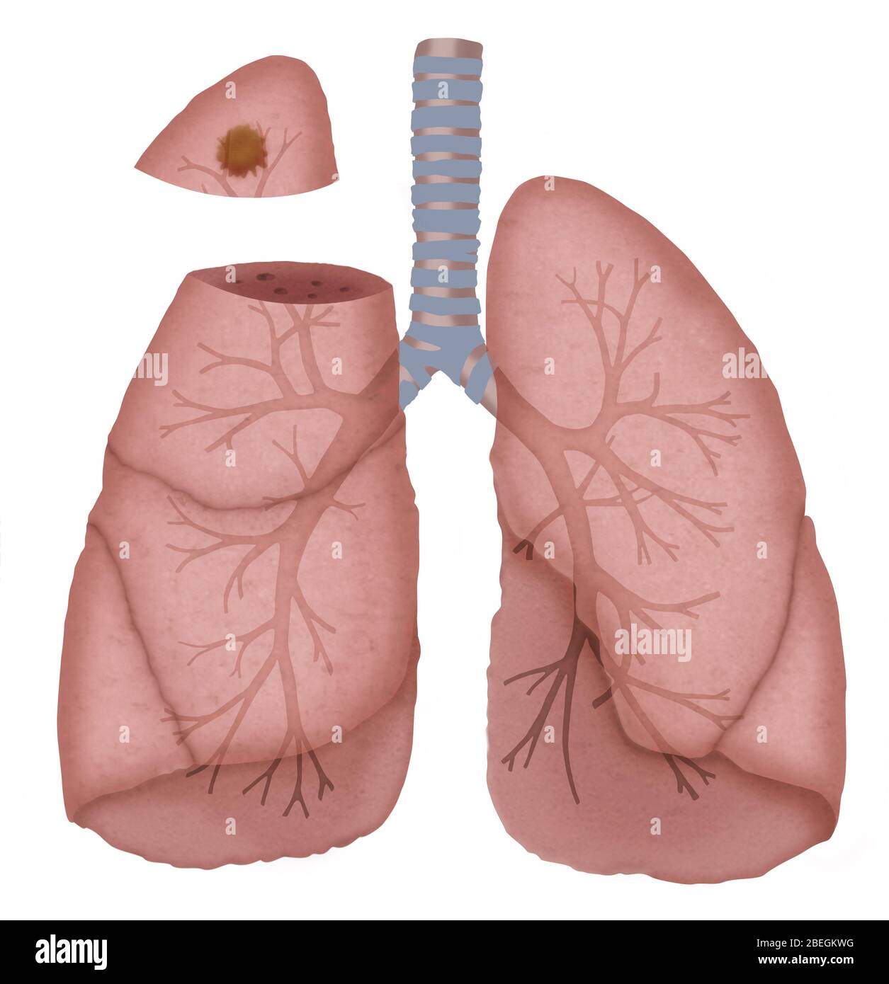 Cancro del polmone Foto Stock