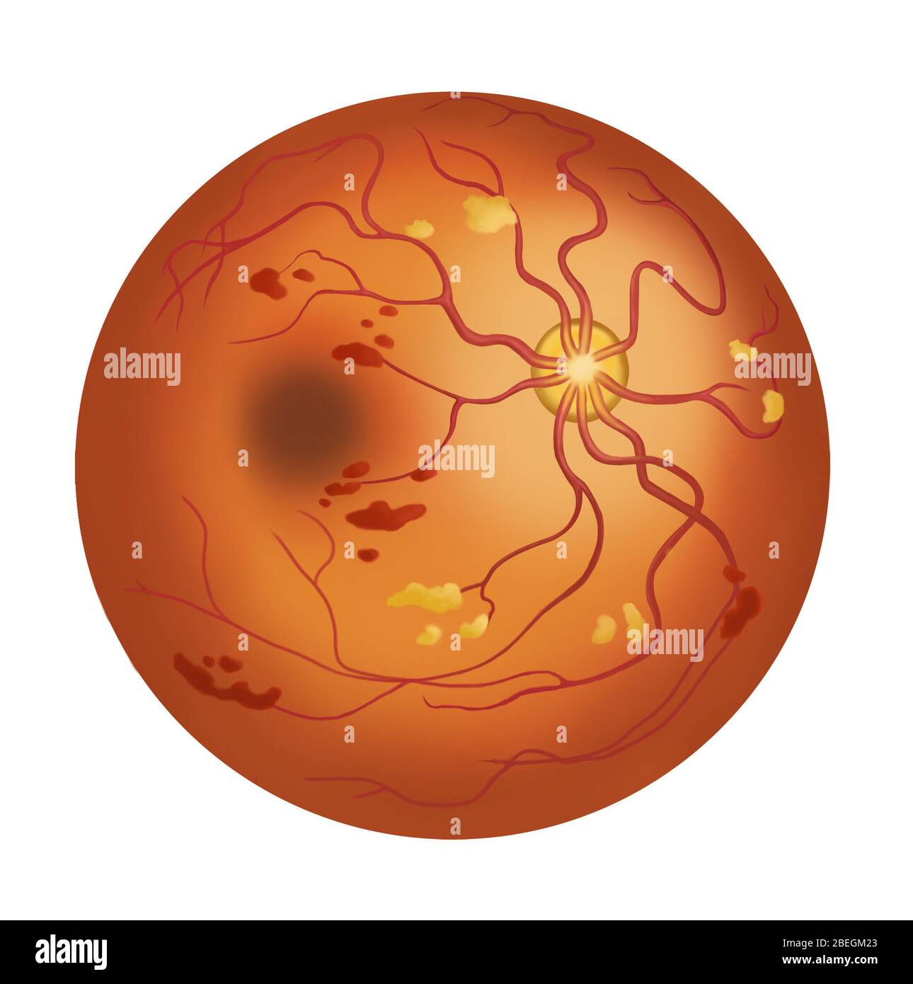 Ipertensione retinica Foto Stock